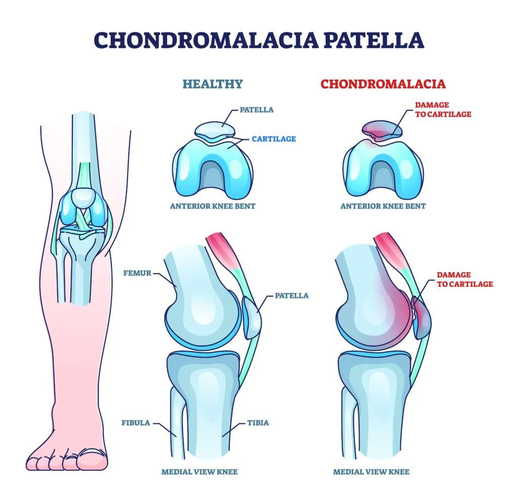 Chondromalacia patella diagram