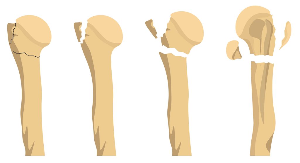 Diagram of Shoulder Displaced Fracture 