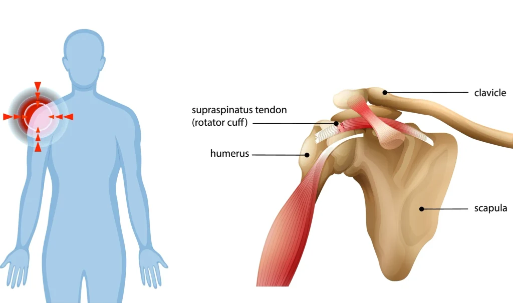 Diagram of rotator cuff tear 