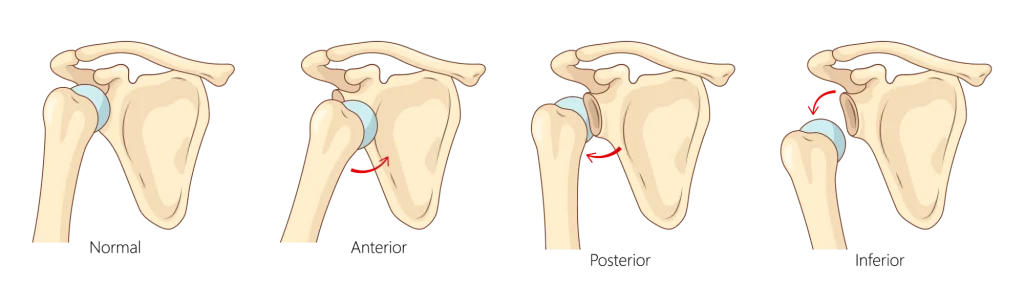 Diagram of the types of shoulder dislocations