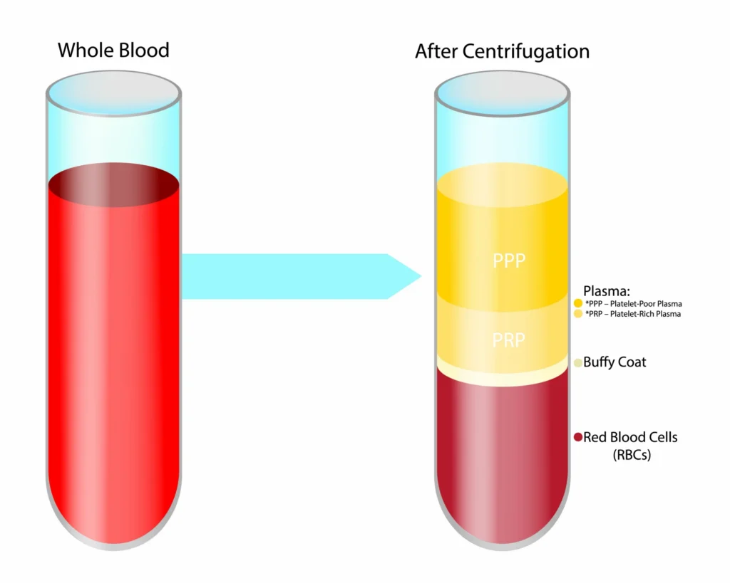 PRP centrifugation process diagram. 