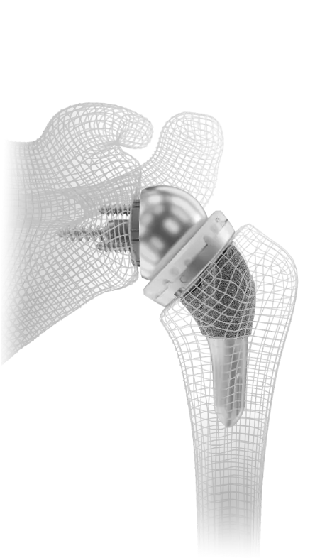 Diagram of reverse shoulder replacement 