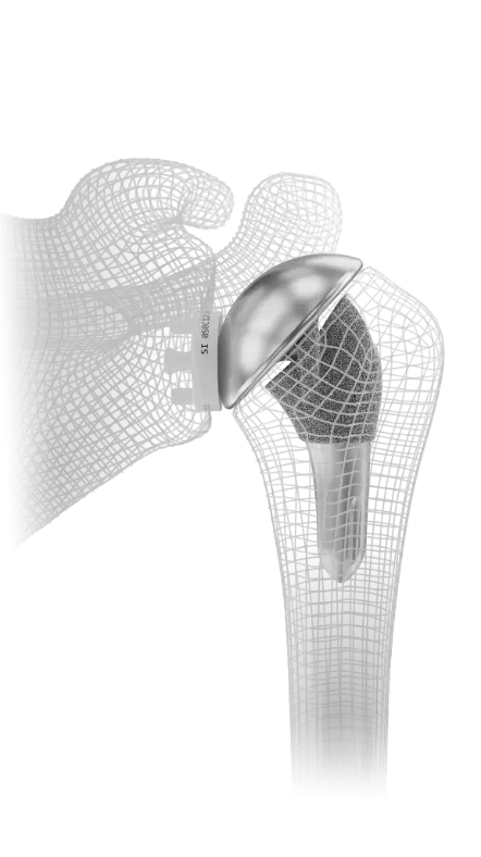 Diagram of total shoulder replacement 