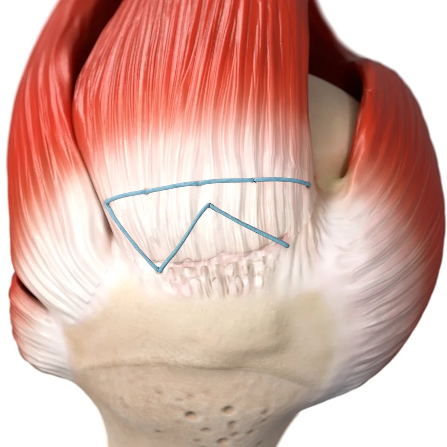 ActiveCuff™ rotator cuff repair showing the TENDON SEAM™ continuous-suture construct compressing the tendon to bone