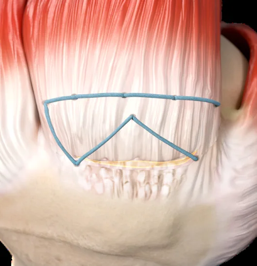 ActiveCuff™ TENDON SEAM™ repair with the tendon footprint on the bone highlighted
