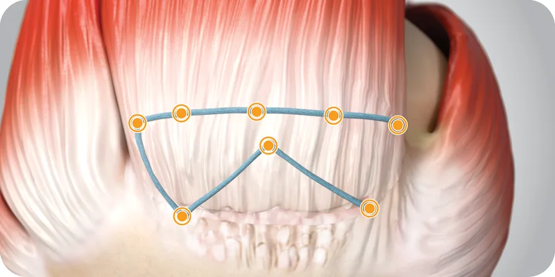 Continuous-stitch construct with multiple interconnected fixation points across the rotator cuff