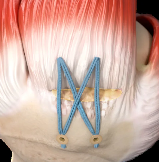 Traditional rotator cuff repair using two anchors and tied knots
